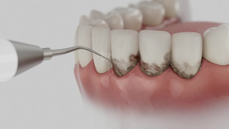 Trusted Wisdom Tooth Removal service in Buckhannon, WV - Dentist Open Now